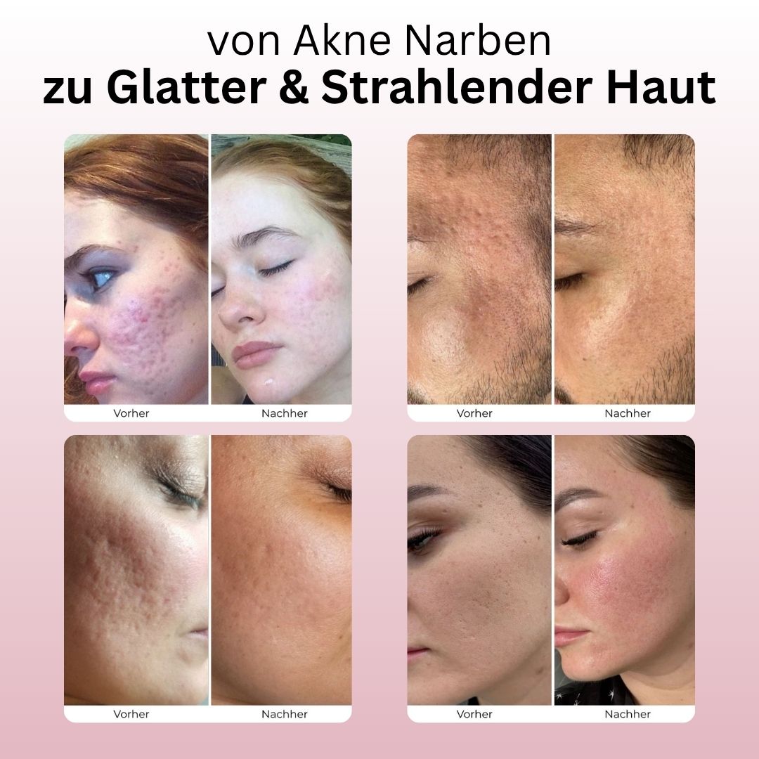 Delora Microneedling Infusion System